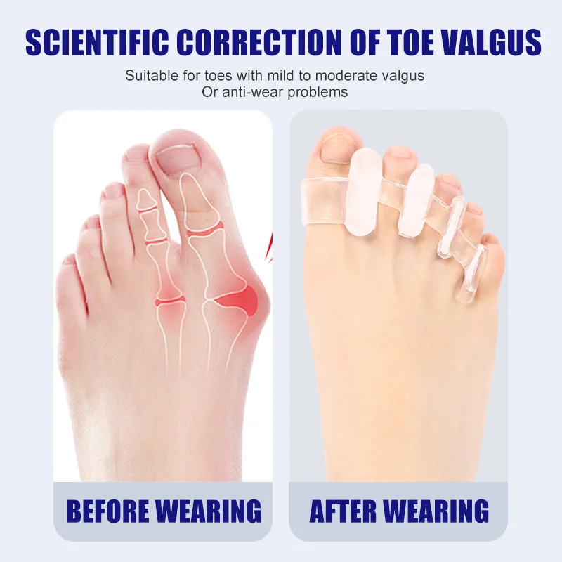 1 para silikonowy Separator pa – Toe Separator Silicon recenzja i cena