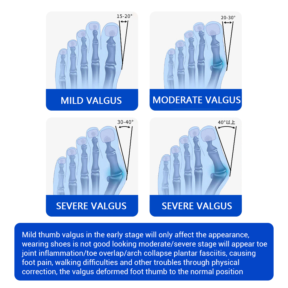 Regulator na haluksy, regulowa – Toe Separator Silicon recenzja i cena